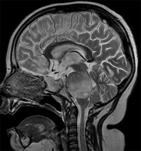 MRI of the Brain Image