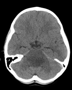 Head CT Image